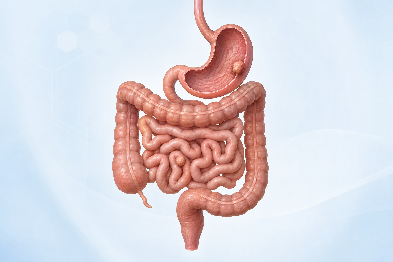 Digestive tract illustration showing possible GIST locations in the stomach and small intestine